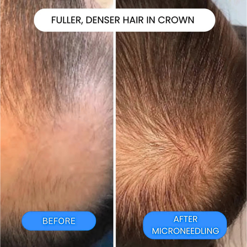 ORYN™ - Peptide Infusion Hair Regrowth System